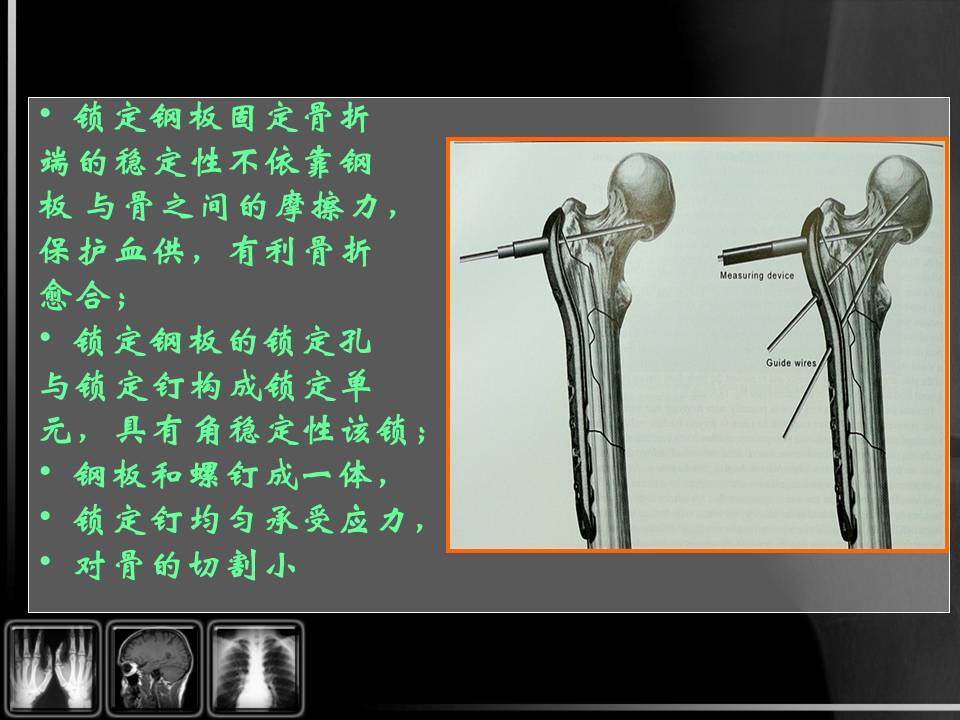 由于粗隆部血运丰富,骨折后极少发生骨不连,但甚易发生髋内翻和下肢短