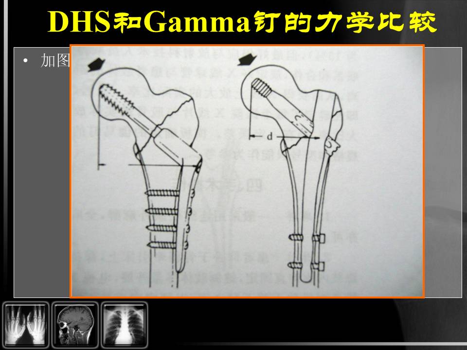 本課程由四川省人民醫院骨科王躍教授詳細介紹了股骨粗隆間骨折的分型