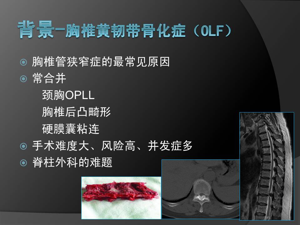 半关节突椎板整块切除治疗胸椎黄韧带骨化症及合并硬膜囊粘连