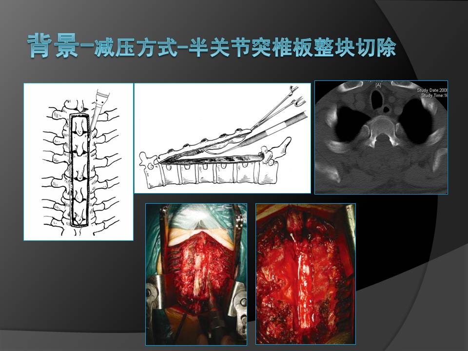 半關節突椎板整塊切除治療胸椎黃韌帶骨化症及合併硬膜囊粘連