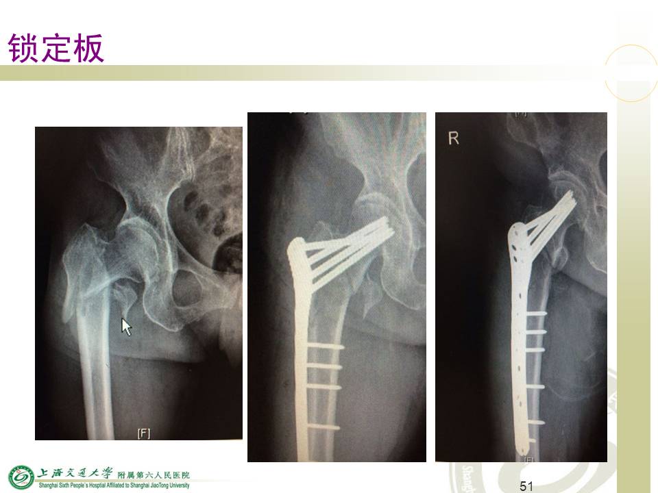 老年髋部骨折救治的策略和技术 -医学文章-唯医,allinmd