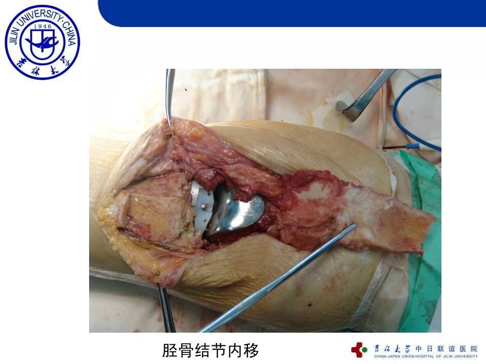 全膝关节置换的截骨原则