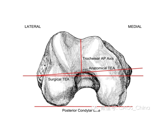 常用的解剖标志包括:解剖通髁线,外科通髁线,前后切迹连线,股骨后髁