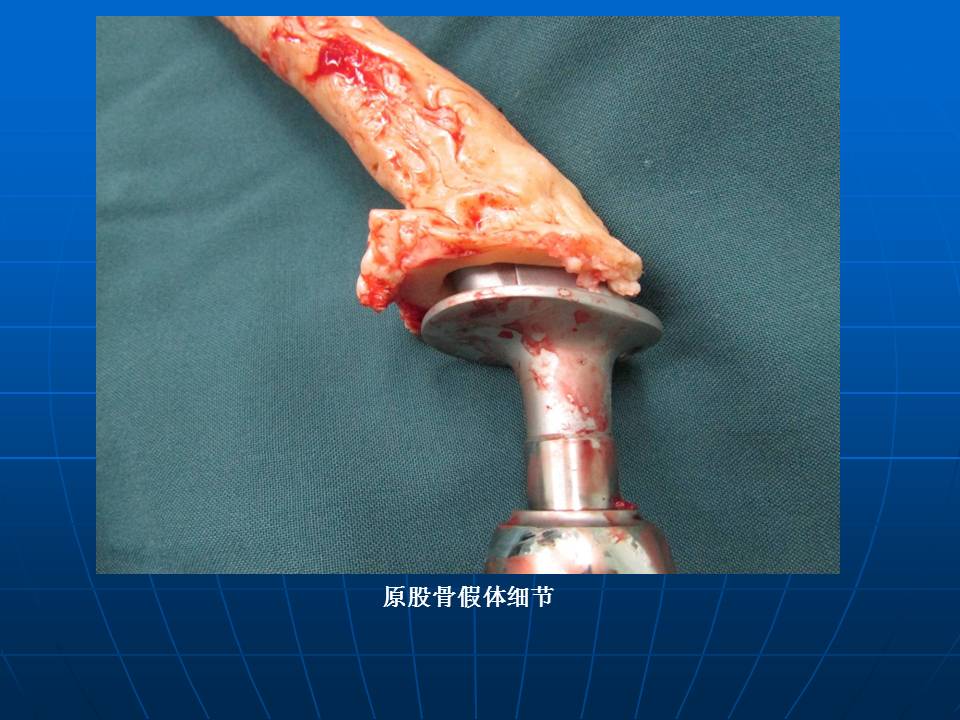 人工全髋关节翻修术中对股骨骨缺损的重建和股骨假体的选择