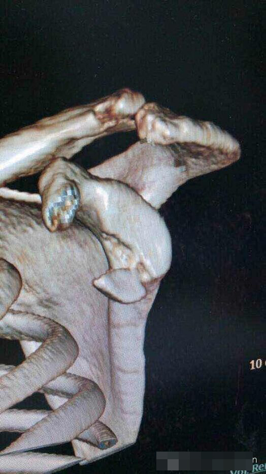 全关节镜下修复肩关节不稳合并肩盂骨折