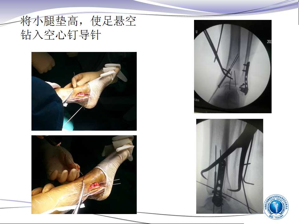 踝关节后外侧及外侧入路