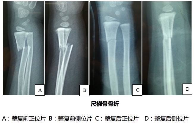 儿童尺桡骨骨折治疗篇