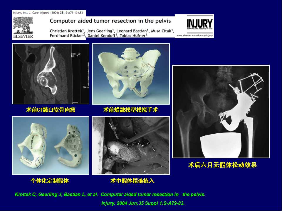 髋臼旋转中心图片