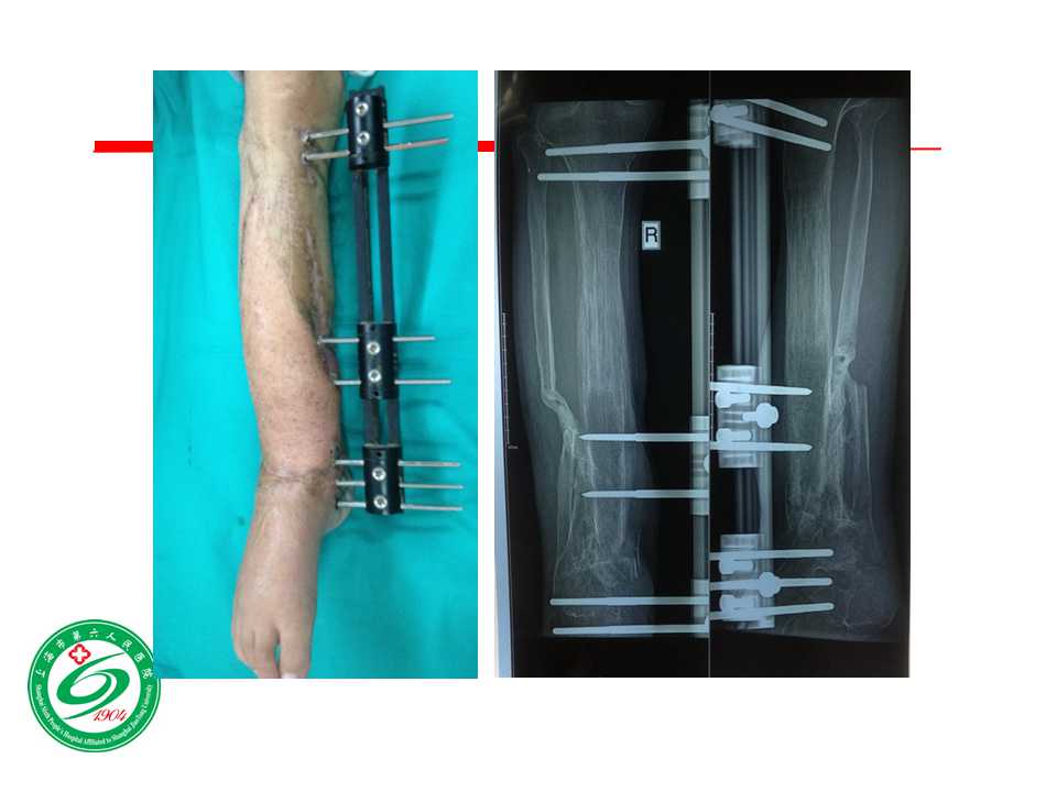 小腿软组织缺损的骨外固定治疗