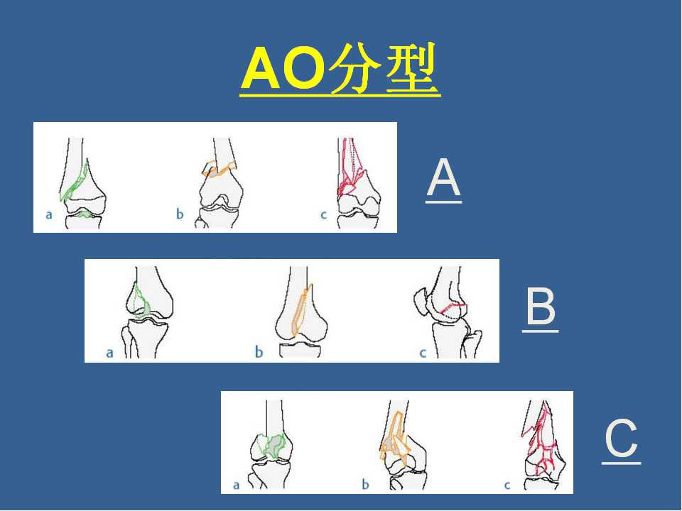 股骨远端骨折