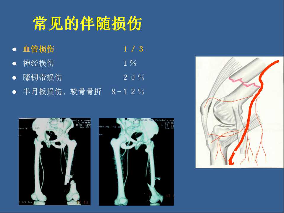 股骨远端骨折分型图片