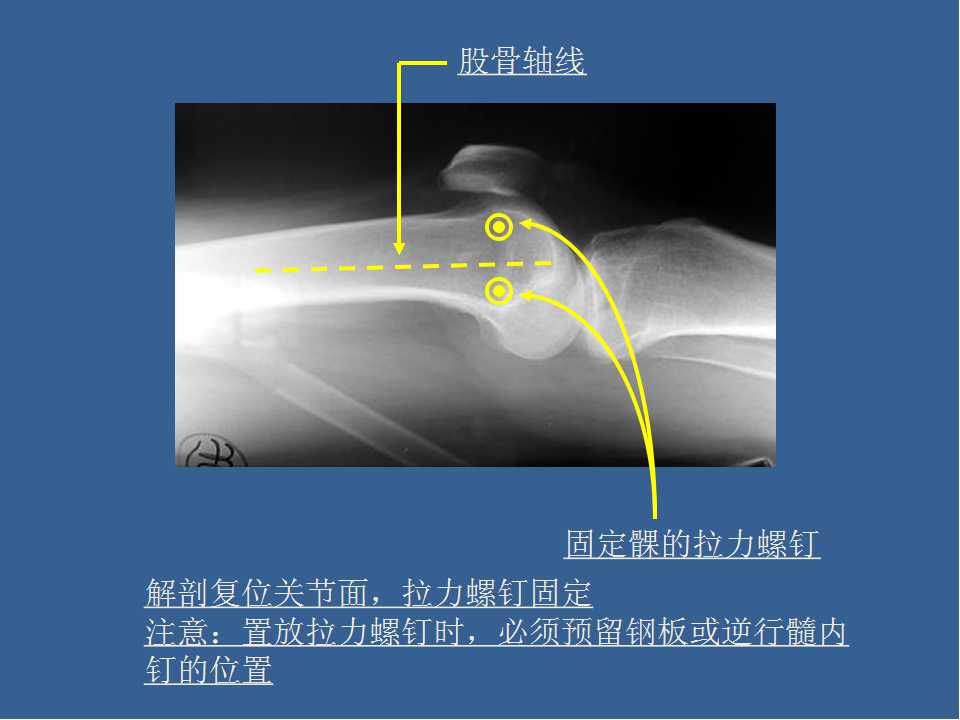 股骨远端骨折