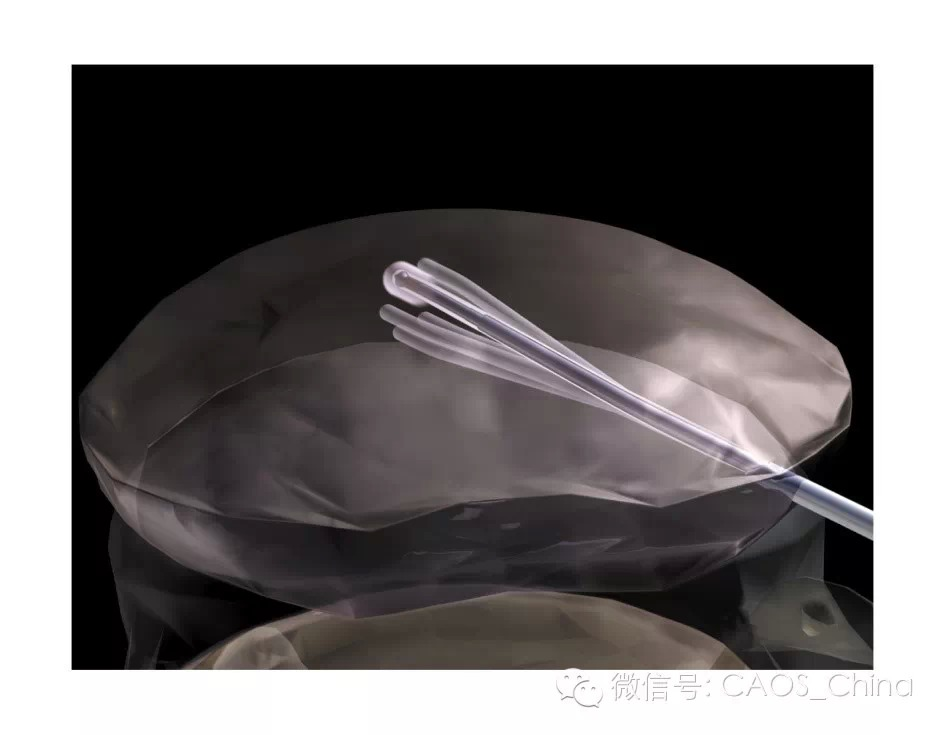 腰椎间盘突出的介入治疗是什么原理(3)