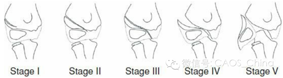 需要通过闭合或者开放复位,重建肘关节和生长板的解剖序列