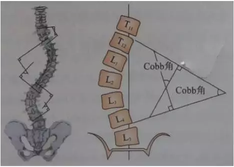 對於較大的彎曲,這兩條直線在x線片上可相交,其交角即為cobb角;而對於