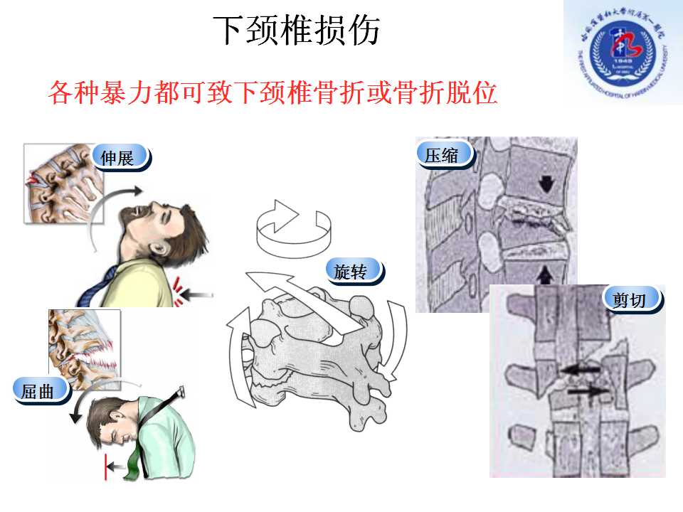 下颈椎损伤是临床上常见的一类疾病,主要是有外伤所致的下颈椎骨折