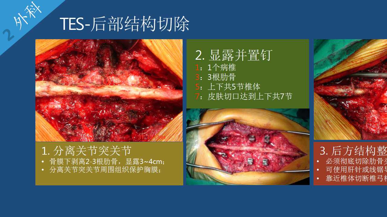 脊柱转移癌的手术治疗策略保守or积极