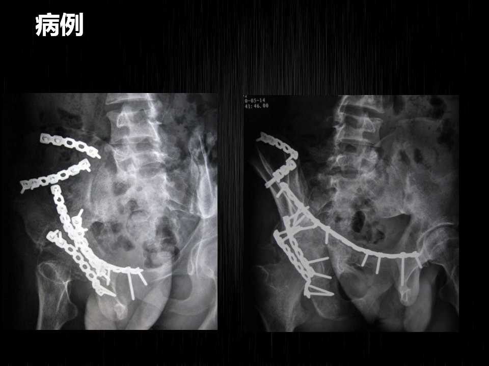 髋臼骨折钢板图片