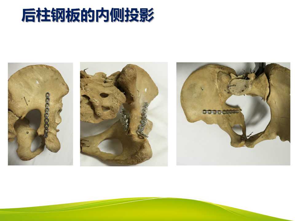 髋臼骨折钢板图片