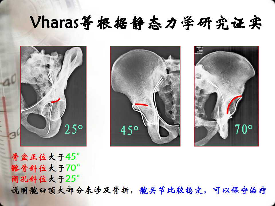 髖臼骨折的分型及影像學診斷