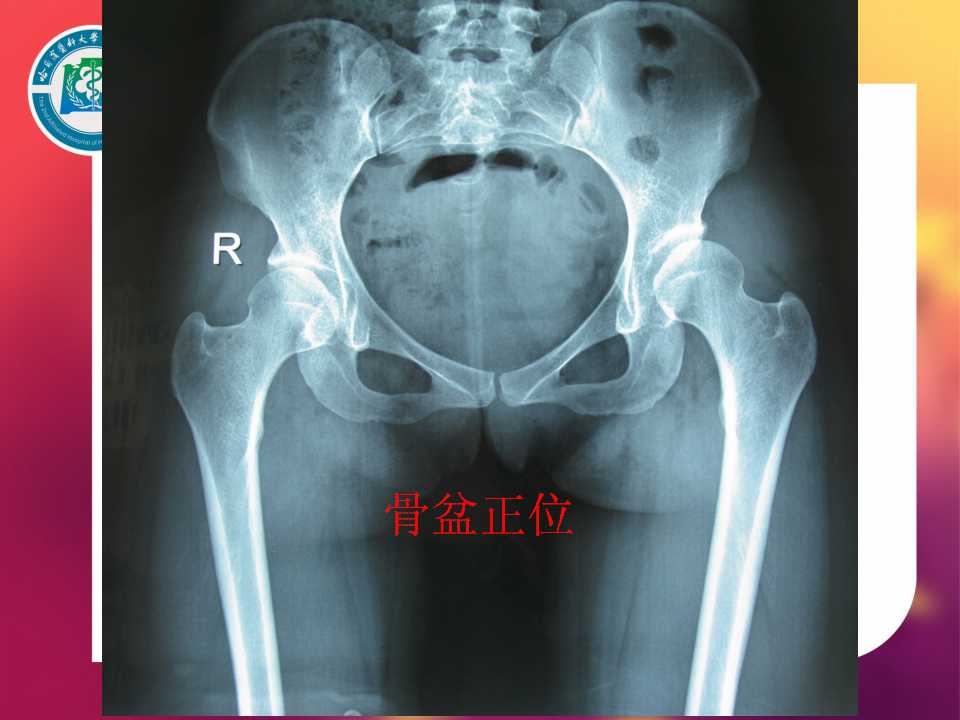髋臼旋转截骨:手术技术与初步结果