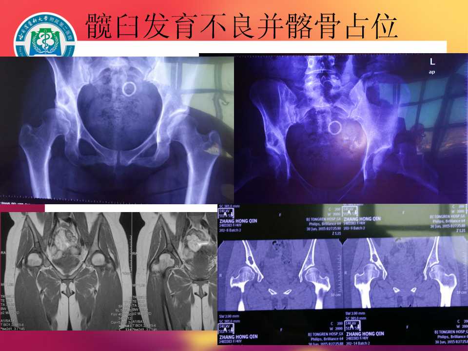 髖臼旋轉截骨:手術技術與初步結果