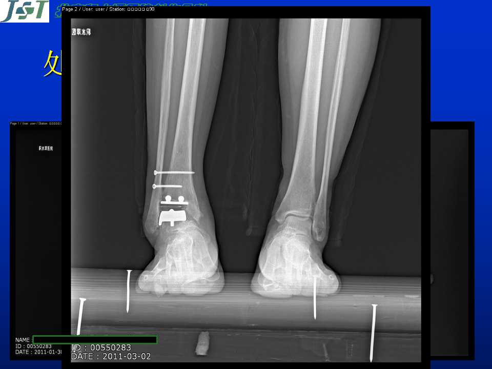 人工踝关节置换的并发症及处理