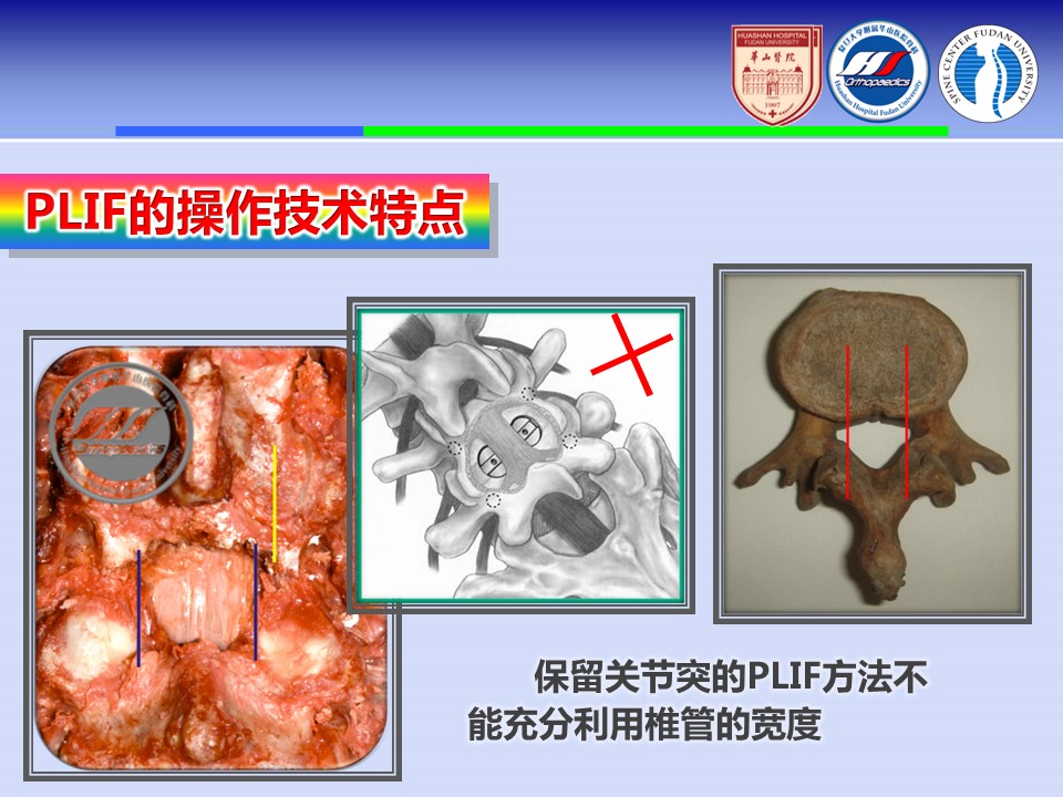 腰椎改良tlif手术演示