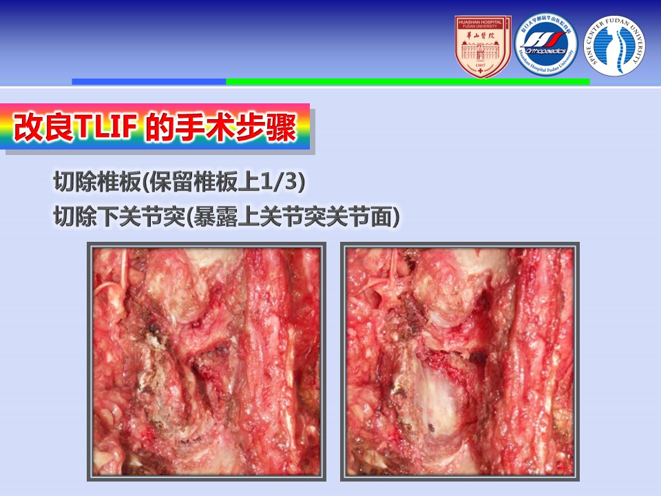 腰椎改良tlif手术演示