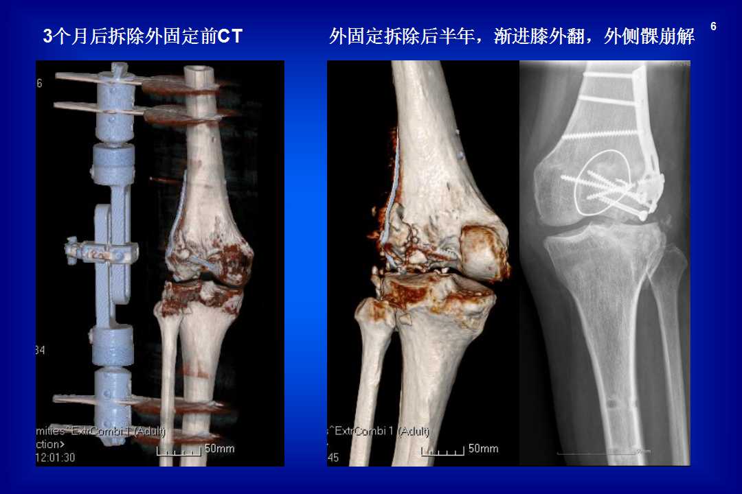 浙江大学附属二院的严世贵教授从一例严重膝关节开放伤入