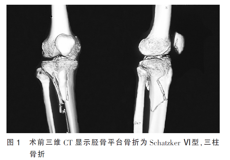 波及後髁的脛骨平臺骨折手術入路選擇