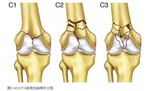 股骨远端骨折分型图片