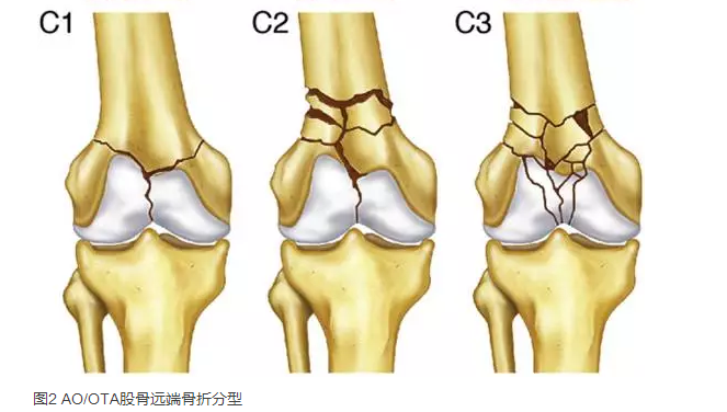 右股骨远端图片