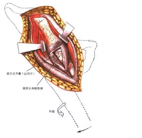 坐骨结节手术示意图图片