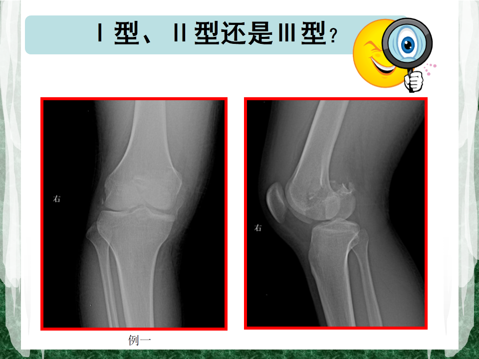 hoffa骨折的ct分型和手术治疗