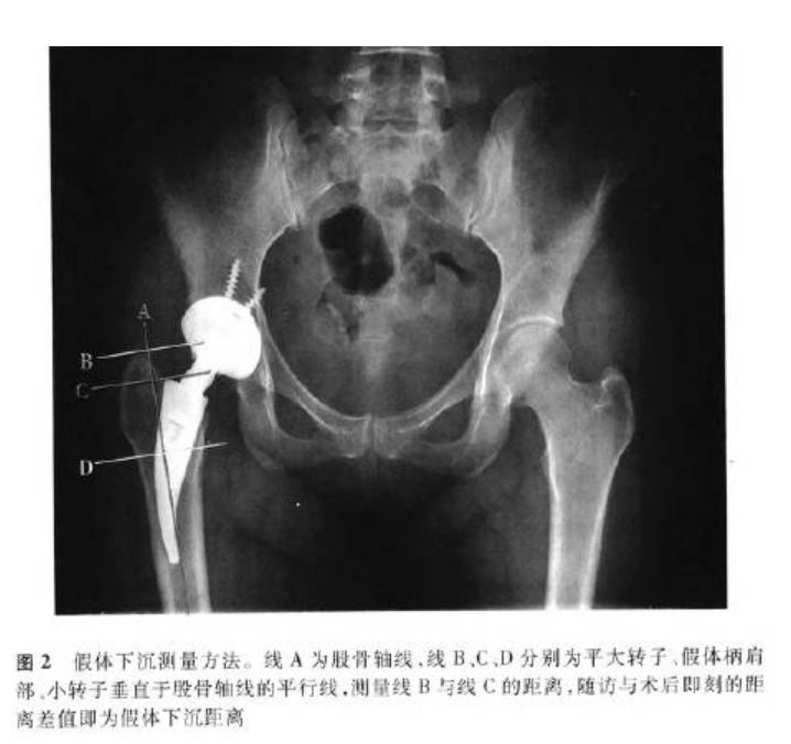 經股骨髓腔畫一條股骨軸線a,平大轉子,股骨柄