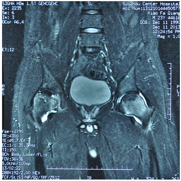 i期 病人有髖部症狀,x線片正常,磁共振出現異常