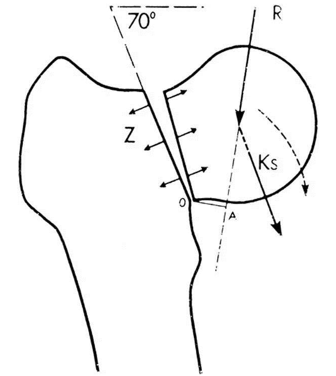 治疗pauwels 3 型股骨颈骨折,dhs疗效更显著