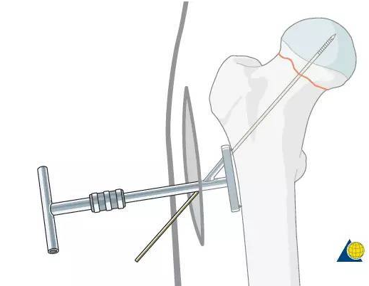 治疗pauwels 3 型股骨颈骨折,dhs疗效更显著