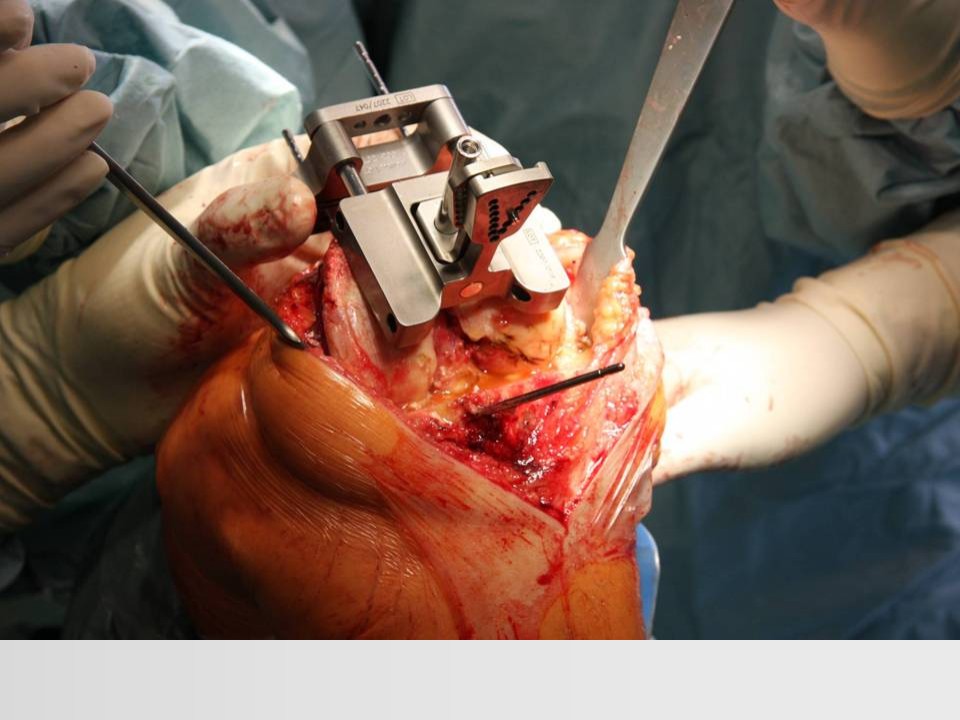 全膝关节置换术成功的关键