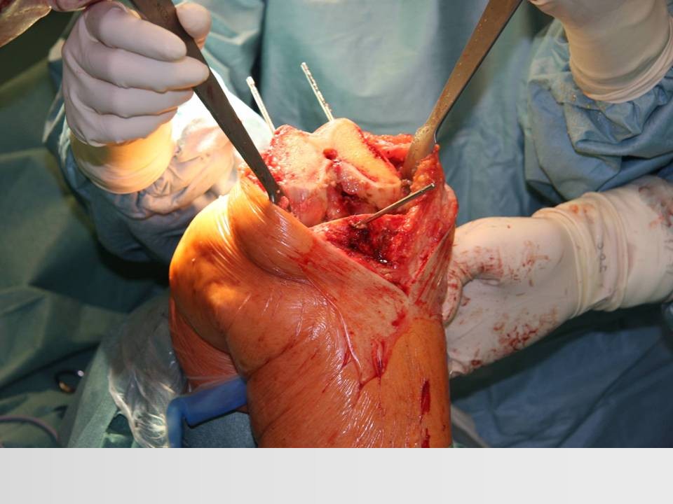 全膝关节置换术成功的关键