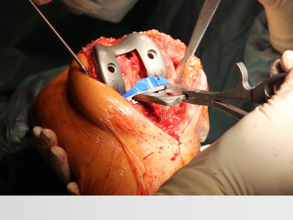 全膝关节置换术成功的关键