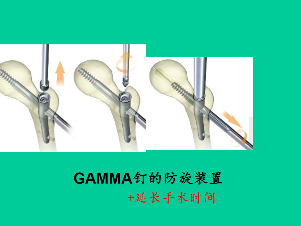 pfna与gamma钉itst治疗骨质疏松性股骨粗隆间骨折的评价