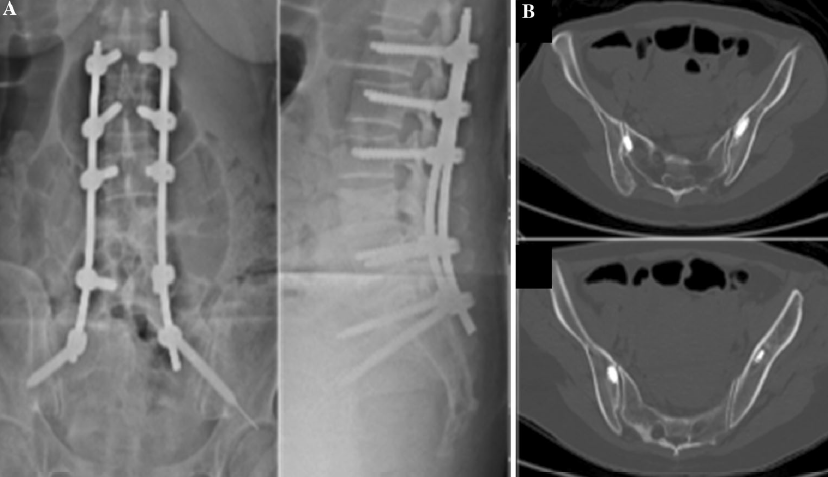 骨科前沿微創髂骨螺釘固定治療疼痛性腰骶椎骨轉移畸形技術描述和臨床