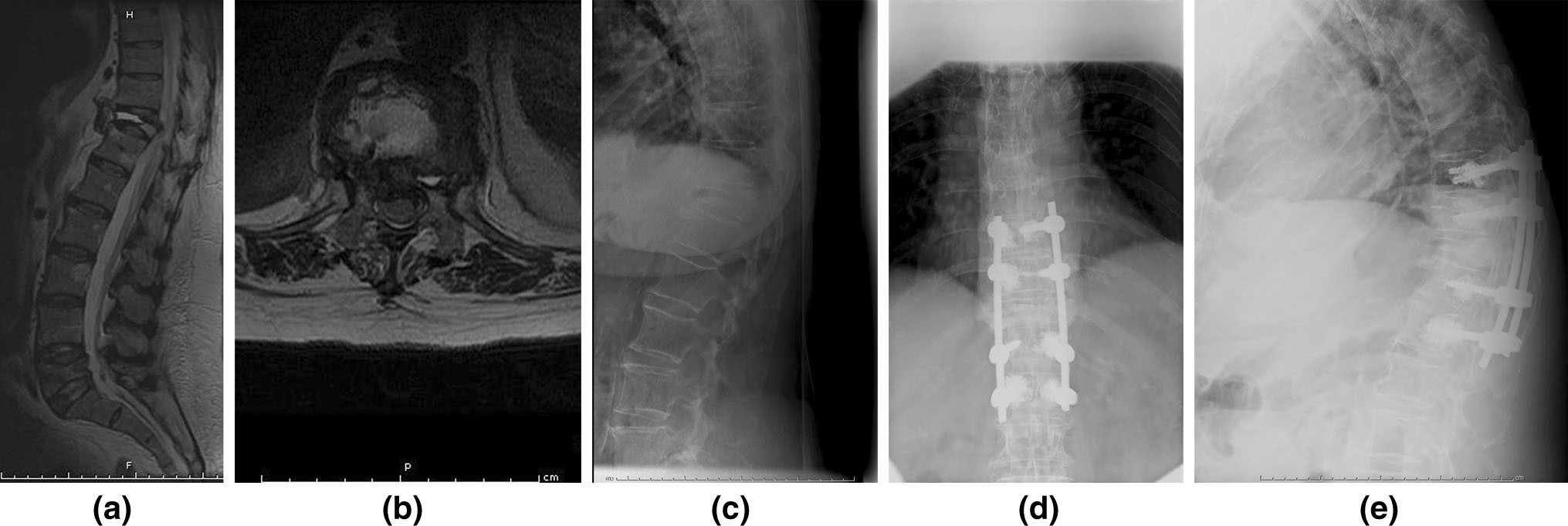 d,e示:胸腰椎正侧位x线示:伤椎上下各置入4枚骨水泥强化带孔椎弓根