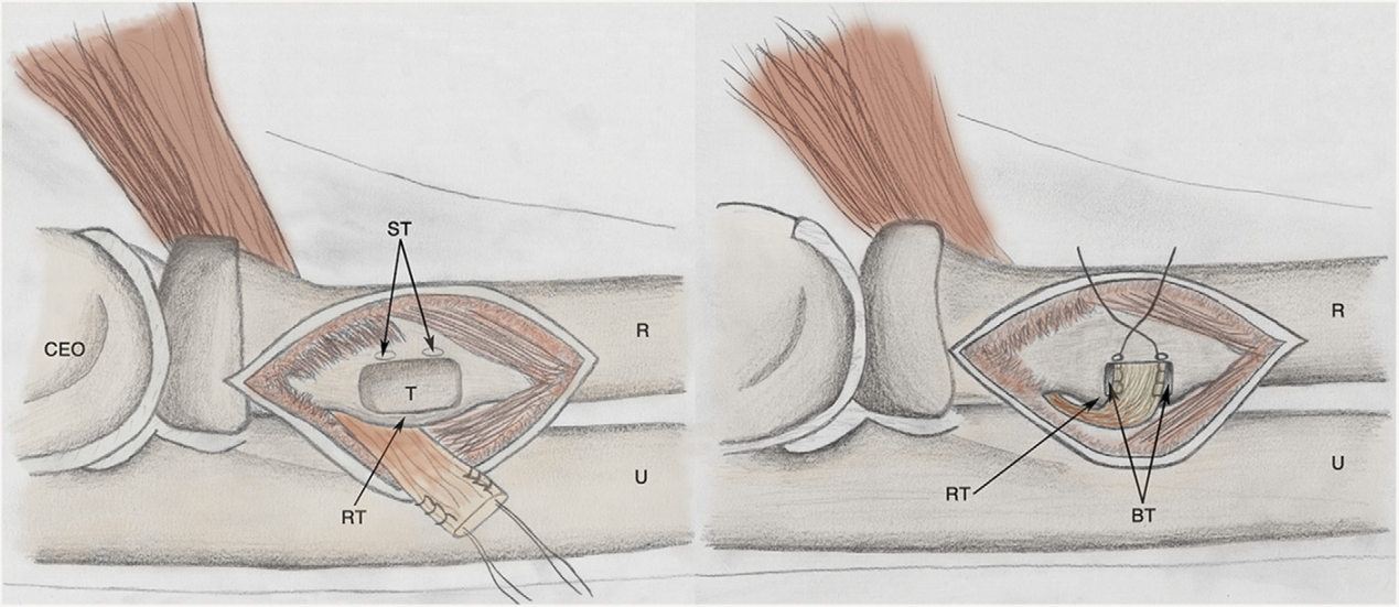 r=桡骨,u=尺骨,rt=桡骨粗隆,st=线结隧道,t=肌腱修复骨槽,ceo=伸肌
