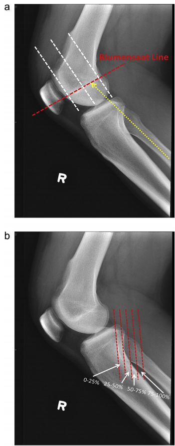 (a) the fibula points to the posterior half of the blumensaat