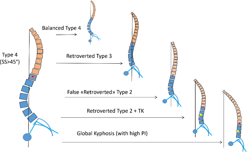 人类退行性脊柱矢状位序列的分类
