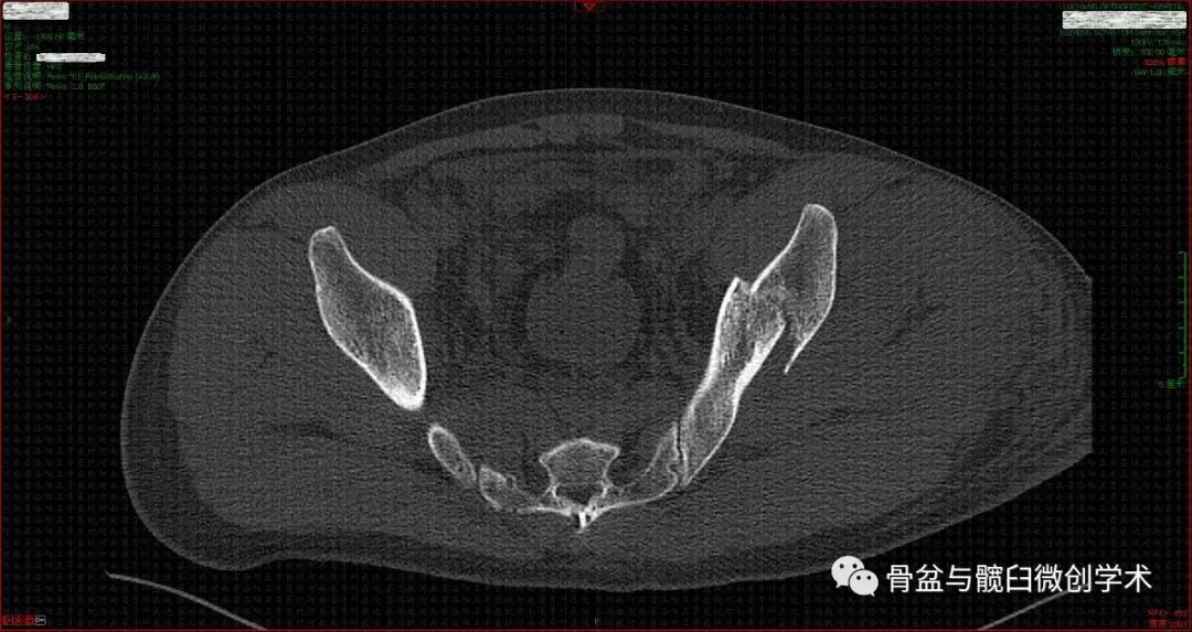 ota61b33型骨盆骨折的微創手術治療