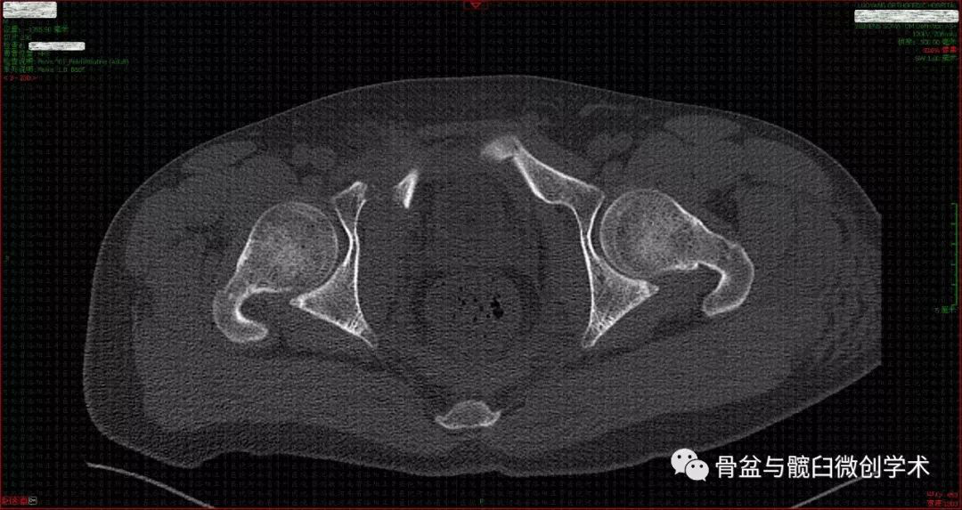 mimics術前設計骶1骶2骶髂螺釘進釘點的髂骨外板投影,可經髂前上棘,髂